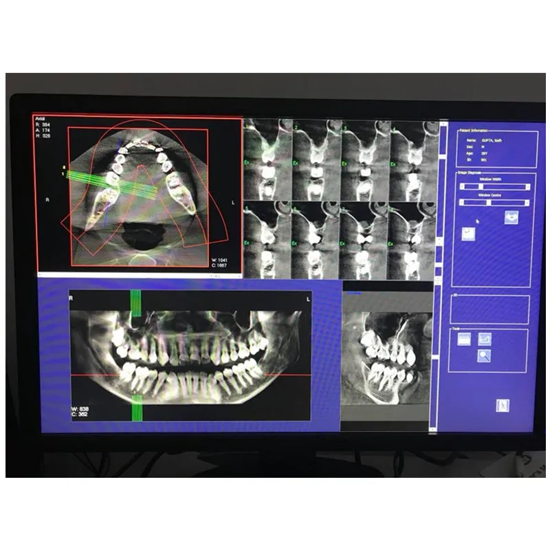 Dental CBCT Digital Dental X Ray Machine  for Oral and maxiloacial Surgery