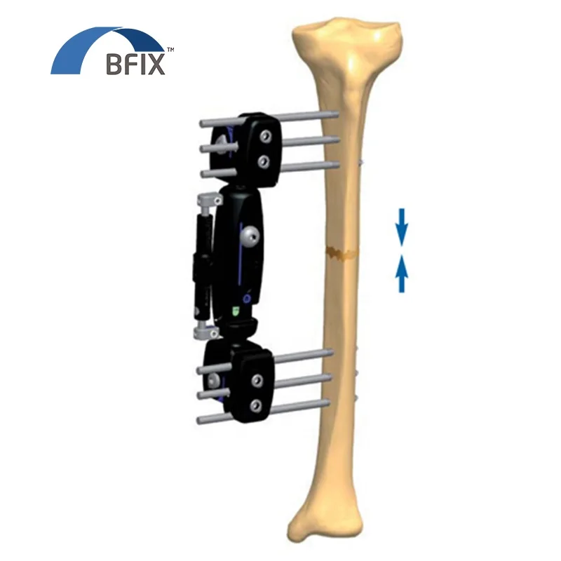 
Bfix Orthopedic Micro Movement Limb Reconstruction External Fixator System 