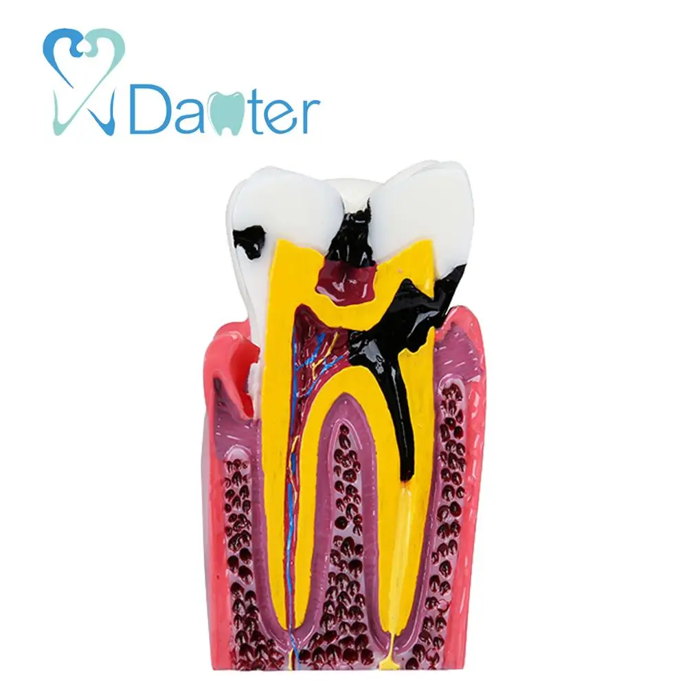 High Quality Caries Model Tooth Model for Dentist Patient Communication