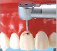 Standard teeth model with 28pcs screw in replaceable teeth for practice preparation