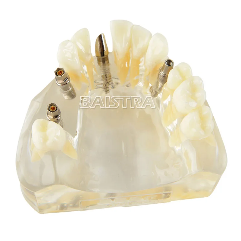 Широко используются пластиковые 4 гвоздя импланты модель зубов Модель