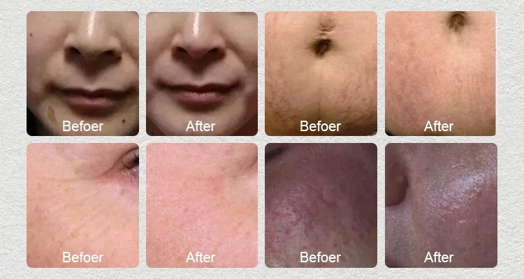 
design surgical scar removal co2 laser fractional pixel laser with RF tube medical CE marked 