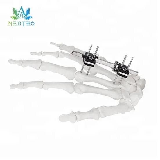 
orthopedic external fixation external fixator Mini Fragment External Fixator for Finger and Palm 