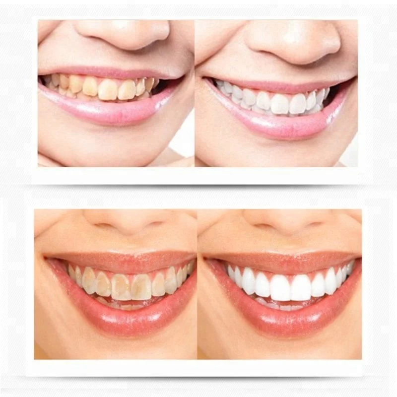 CE Approved High Tech 12 Medical Bulbs Mobile Teeth Whitening Equipment Light