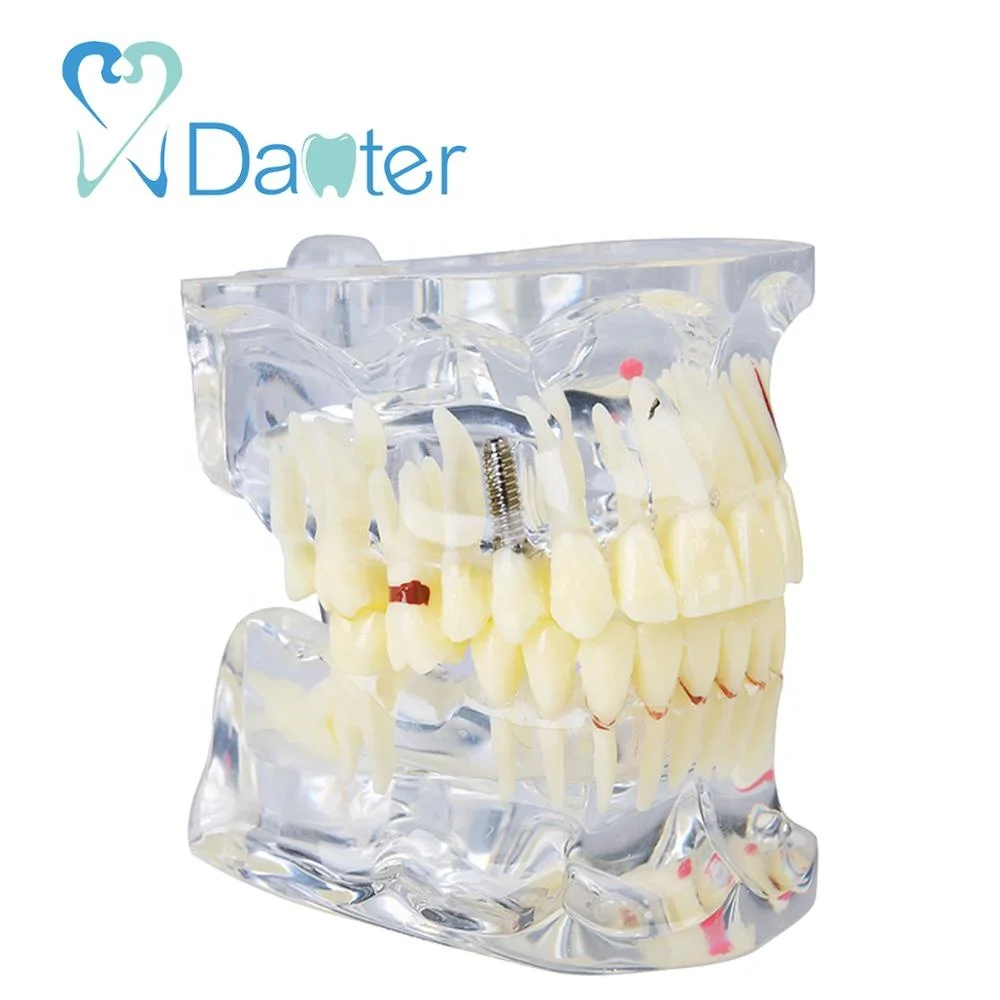 Adult Dental Pathologies Teeth Model with Missing Teeth for showing caries apical cyst tartar implant impaction missing teeth
