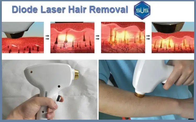 
Distributors wanted factory price hair reduction 808nm diode painless 2000 w 