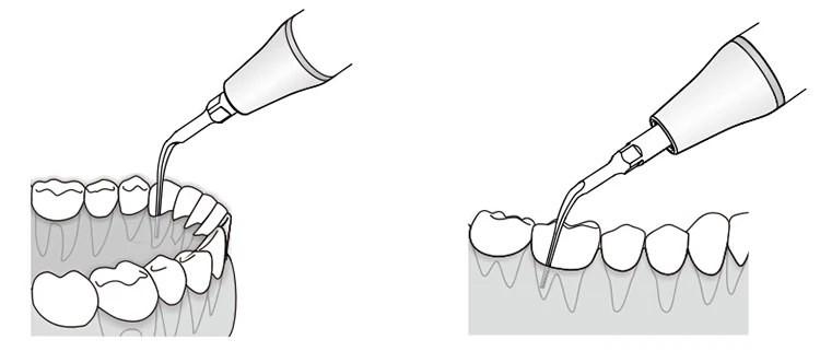 Стандартные практичные ультразвуковые наконечники для зубного скалера
