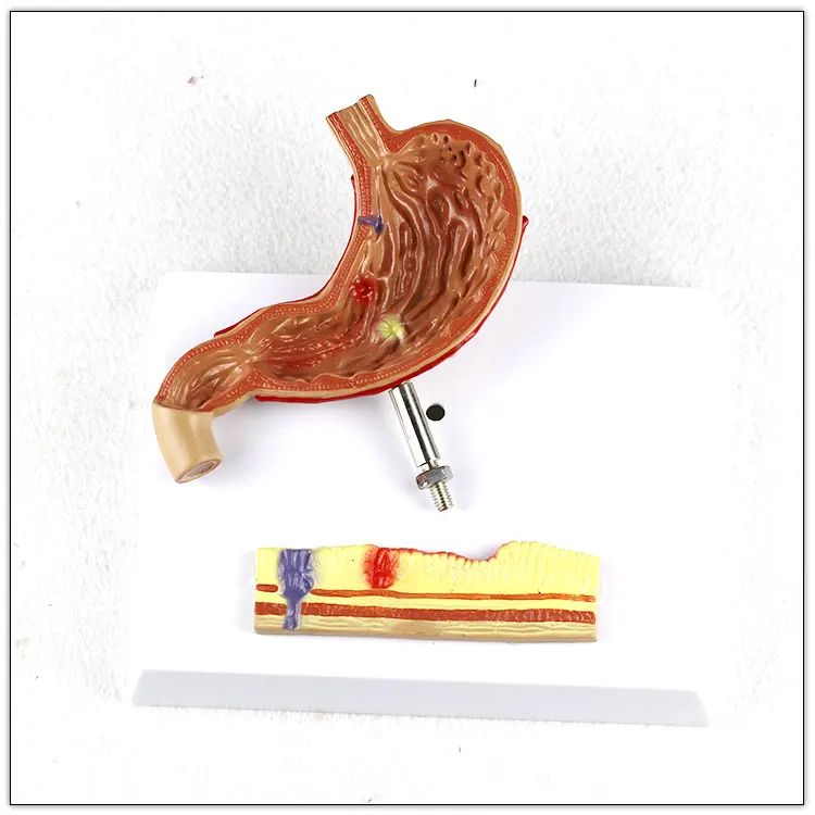 Stomach-Pathological gastric ulcer  Human Digestive System Medical Teaching Anatomical Model visceral model