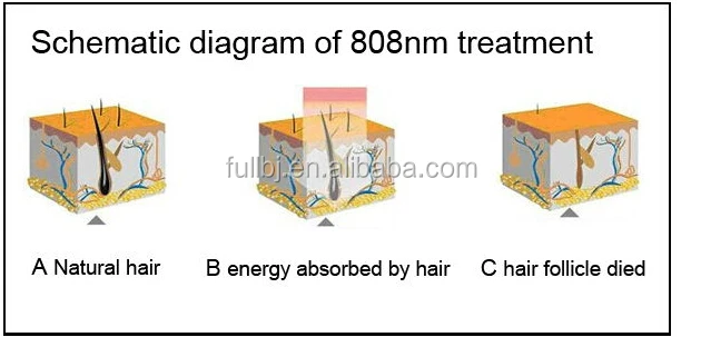 Zona bikini tipi di rimozione dei capelli di laser Zona bikini tipi di rimozione dei capelli di laser