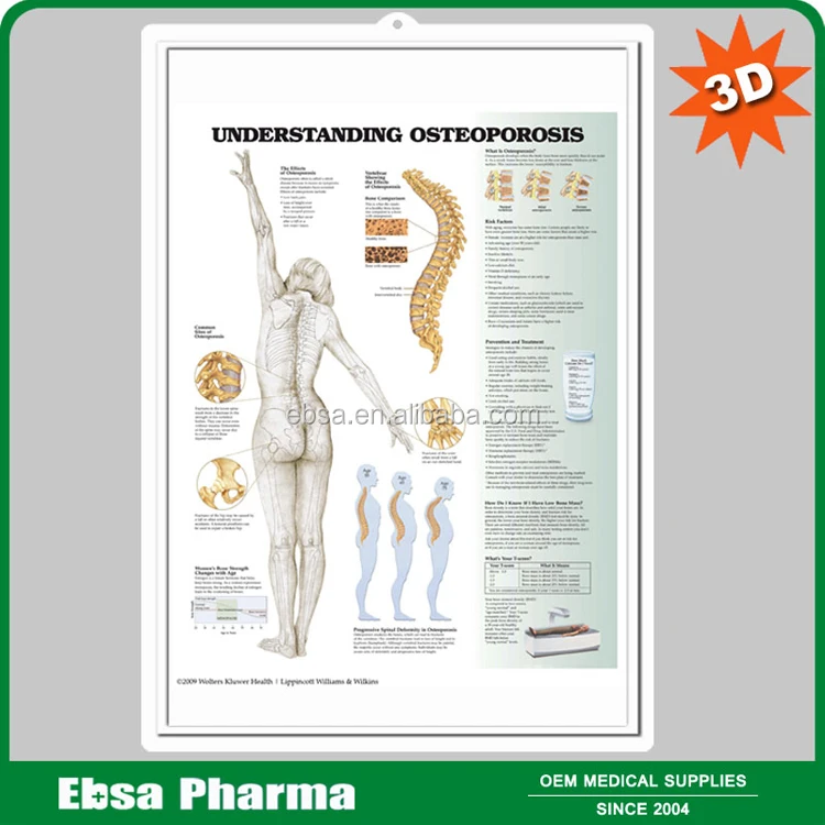 Educational Plastic 3D Medical Anatomical Wall Chart - Understanding Arthritis