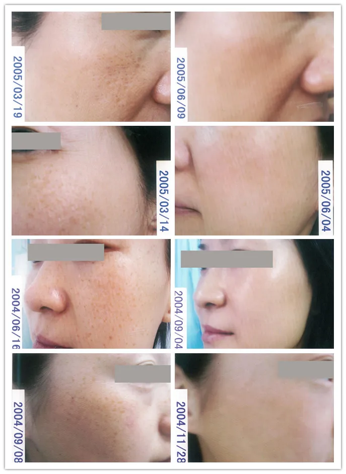 Для только что открытого косметического бизнеса, или вы планируете, 3 в 1, удаление волос, омоложение кожи и многофункциональное удаление пигментов