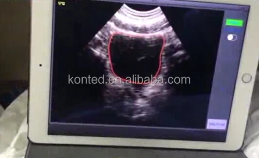 Ipad 4D Wireless Bladder Ultrasound Scanner for Urology