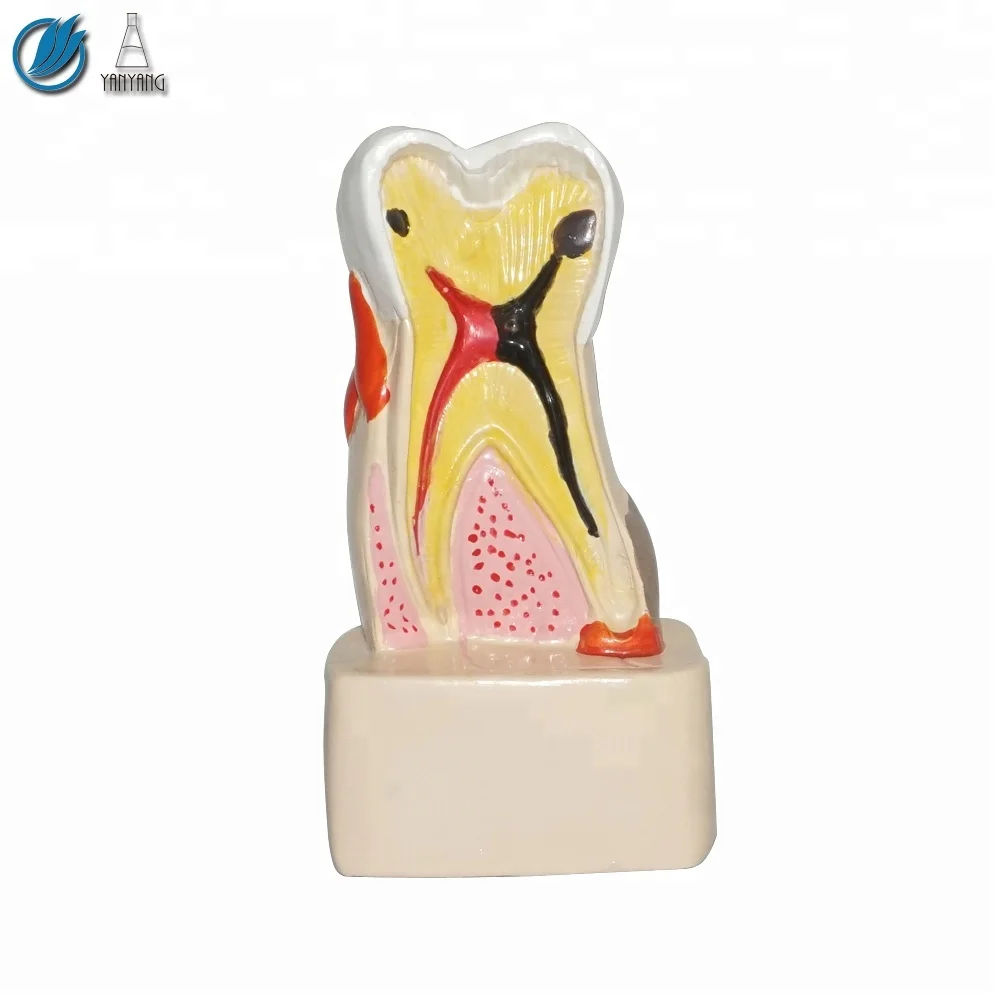Human 4 Times Caries Pathology Dental Model