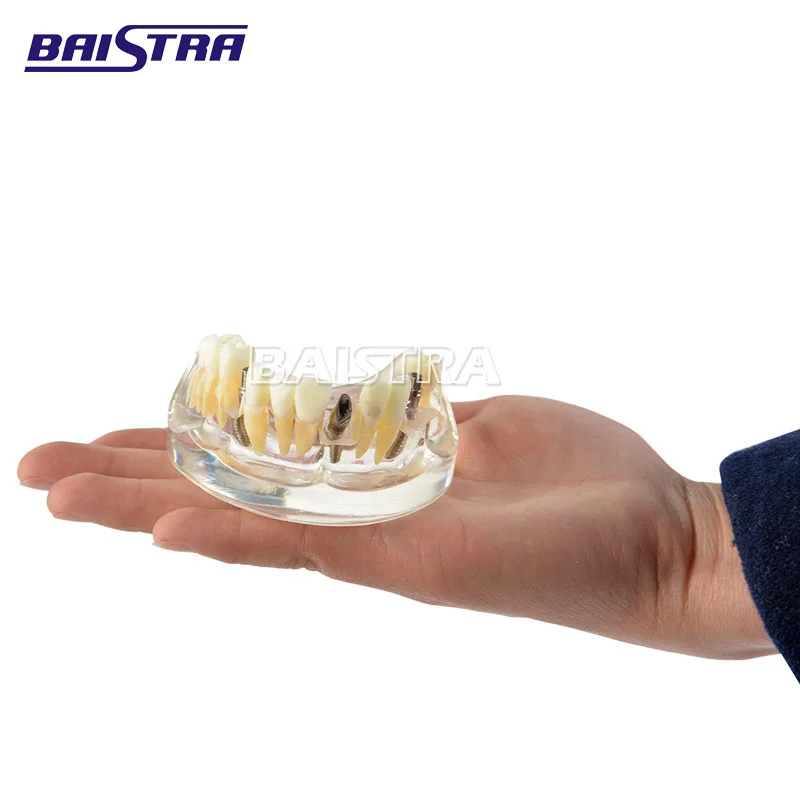 Широко используются пластиковые 4 гвоздя импланты модель зубов Модель