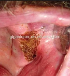 oral hemangioma laser coagulation