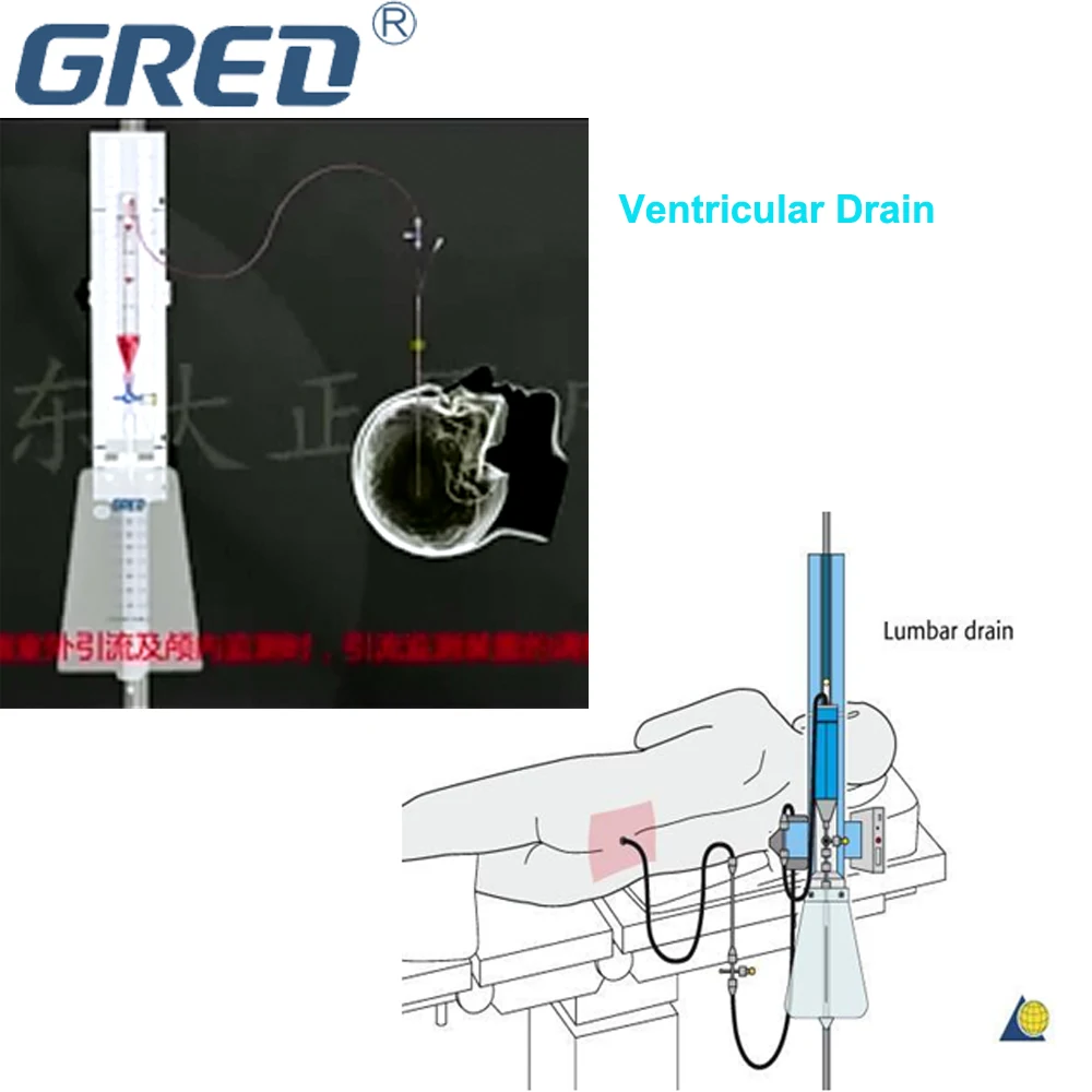 
External Lumbar Drainage System 