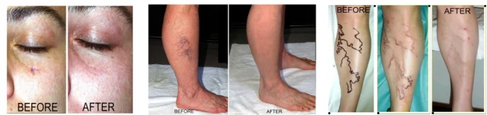 VELASII-30B Varicose Vein Laser/Medical CE/ Veins Removal Laser Machine