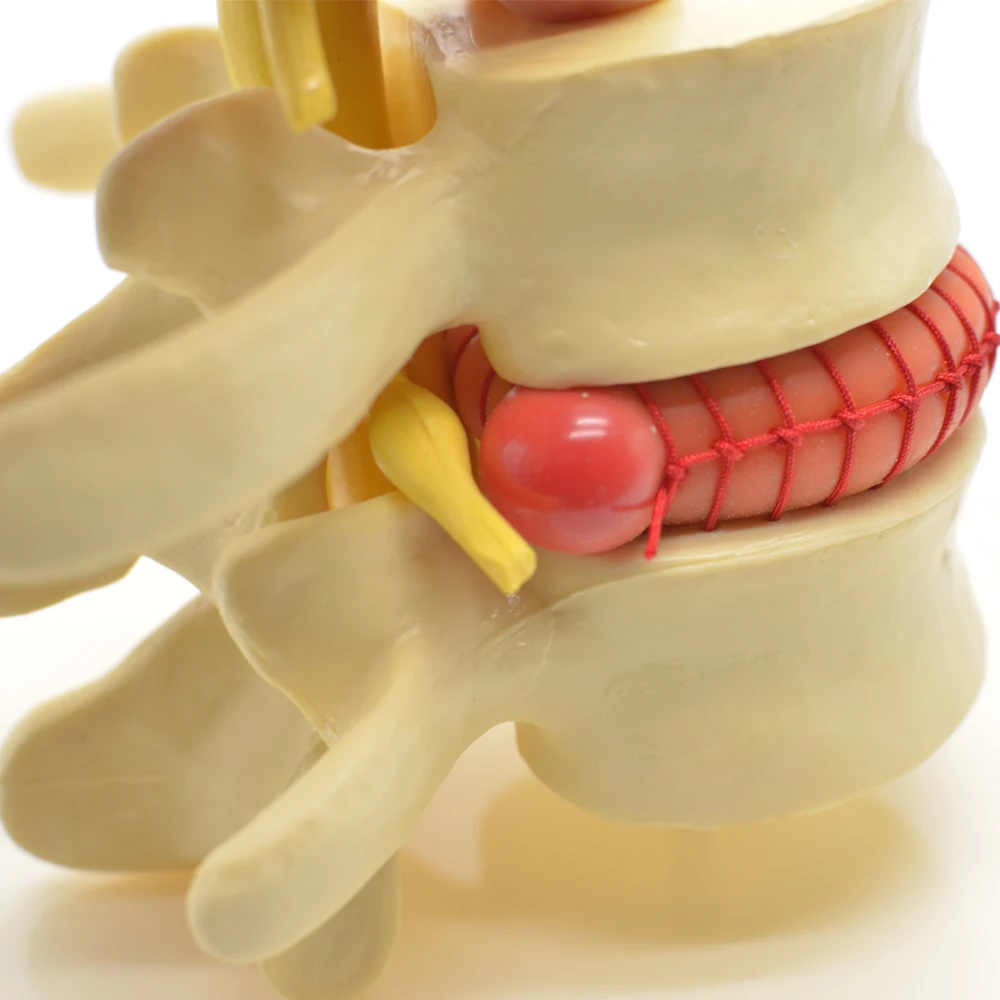 Human Demonstration intervertebral Disc Herniation Model