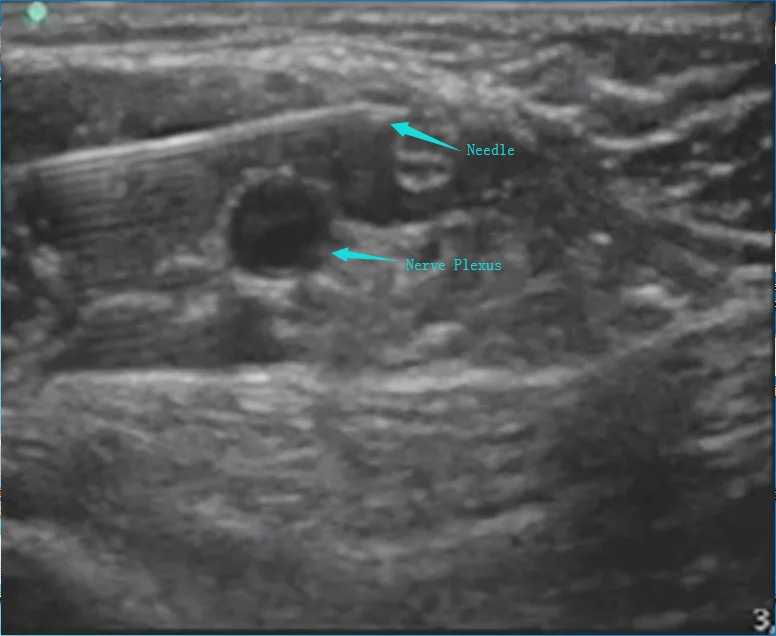 Nerve block plexus needle