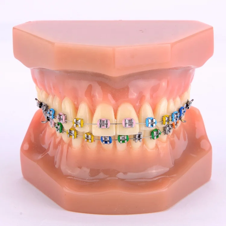 Dental Orthodontic model With metal bracket