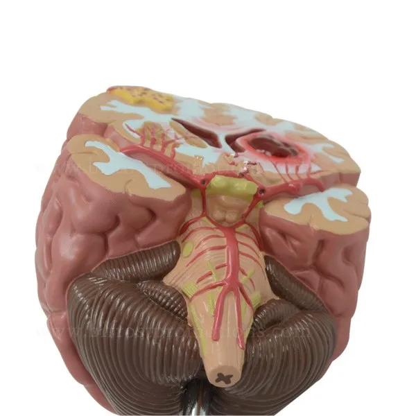 Organs Human Body Anatomy Brain Model Of Stroke