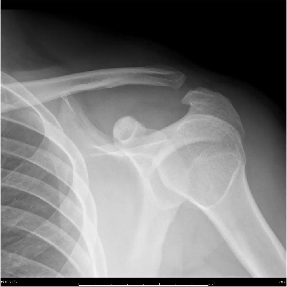 Inkjet medical x-ray film 11*14 inch for HD dicom printer