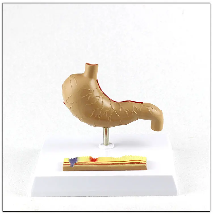 Stomach-Pathological gastric ulcer  Human Digestive System Medical Teaching Anatomical Model visceral model