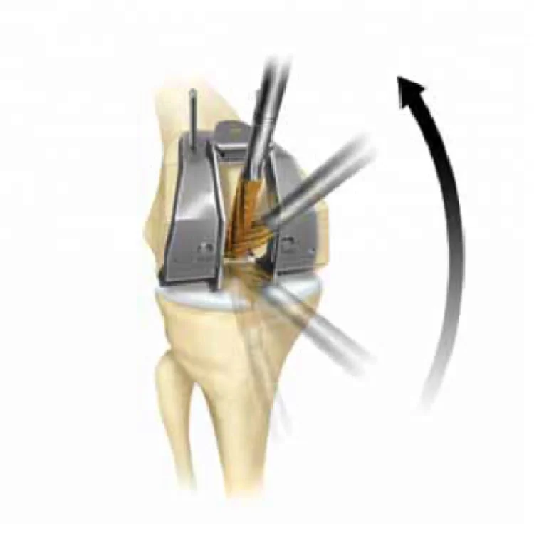 
Primary total knee replacement joint prosthesis 