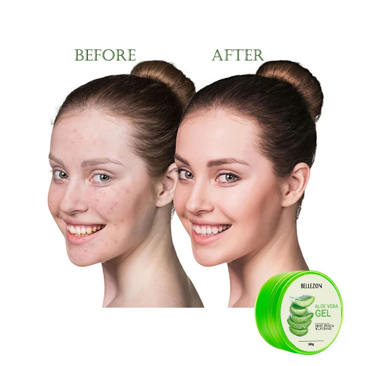 Aloe Vera Moisture Lotion Organic Aloe Vera Skin Care Gel Remove Acne Face Gel