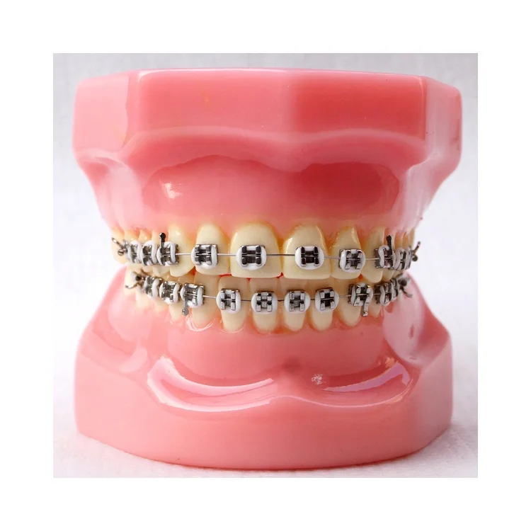 Dental Orthodontic model With metal brackets