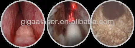 urology diode laser system 120W 1470nm laser