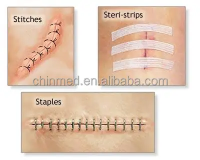 Medical Class Steri-Strip Wound Closure Strips Reinforced Tape 6*38mm