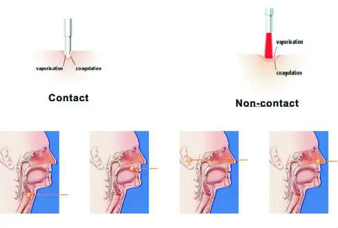 ENT surgery machine with ligasure vessel sealing function