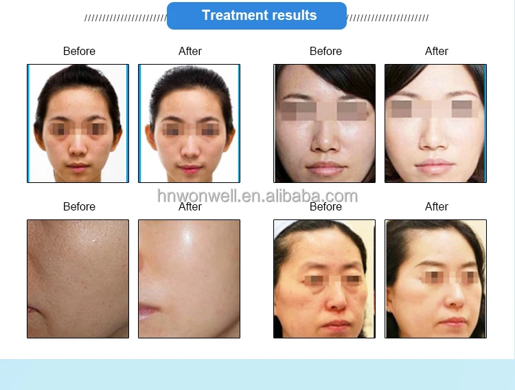 TDA Needle free Mesogun Germany Technology