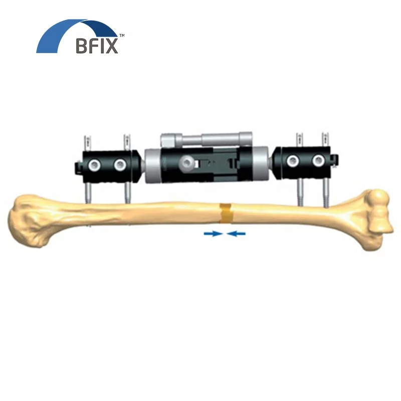 
Bfix Orthopedic Micro Movement Limb Reconstruction External Fixator System 
