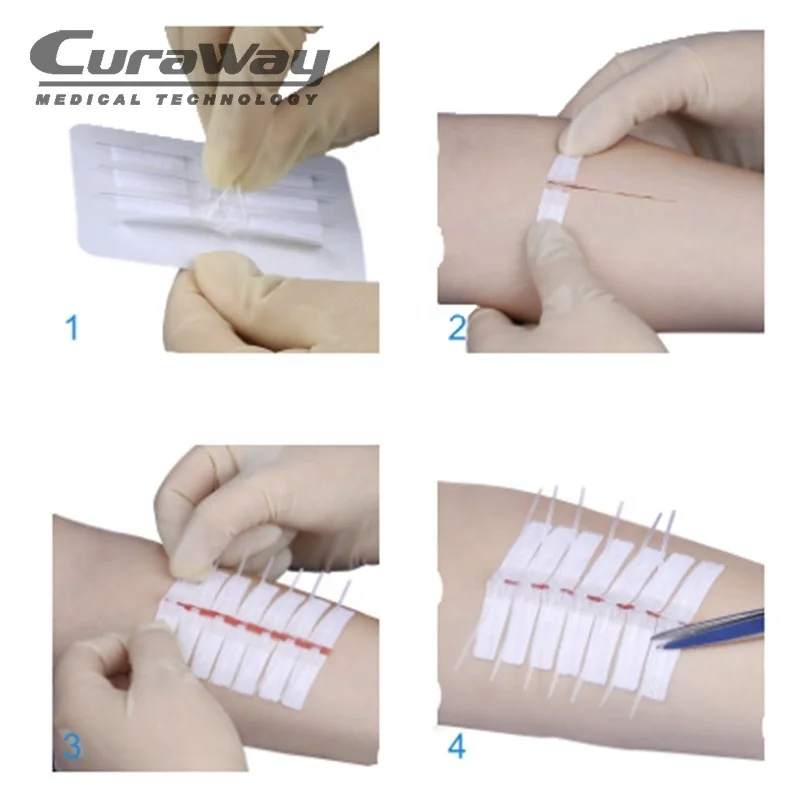 Disposable Medical Supply  Non-invasive Steri Strip Suture Device Surgical Instrument