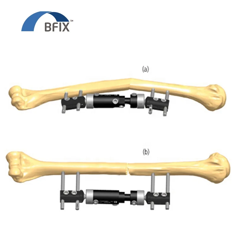 
Bfix Orthopedic Micro Movement Limb Reconstruction External Fixator System 