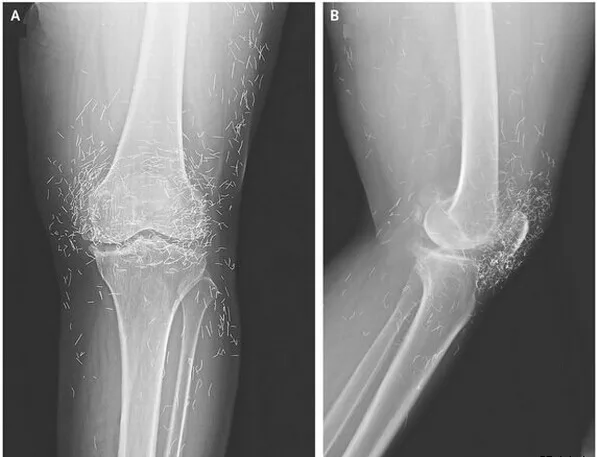 Agfa dt2b 14*17 дюймов x-ray film. fuji медицинской сухой пленки изображений