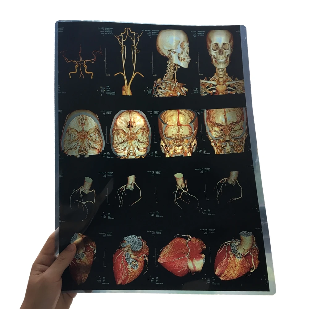 Inkjet medical x-ray film 11*14 inch for HD dicom printer