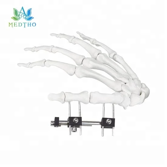 
orthopedic external fixation external fixator Mini Fragment External Fixator for Finger and Palm 