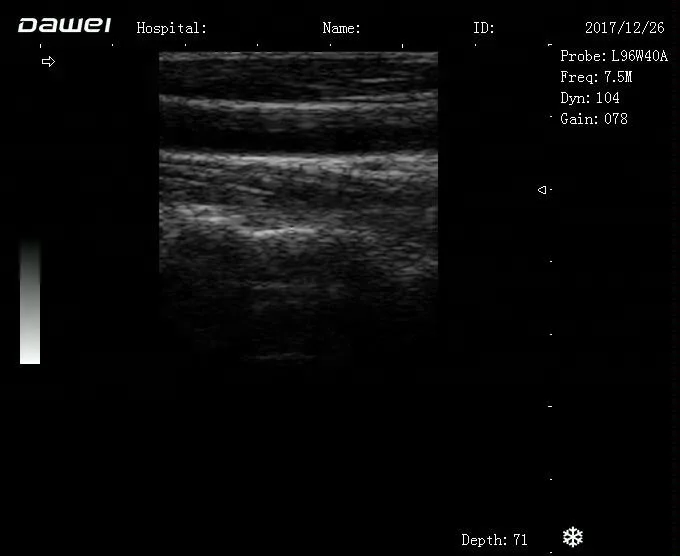laptop ultrasound machine& cheap BW ultrasound scanner with battery DW580
