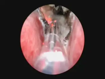 150W Prostate surgery diode laser