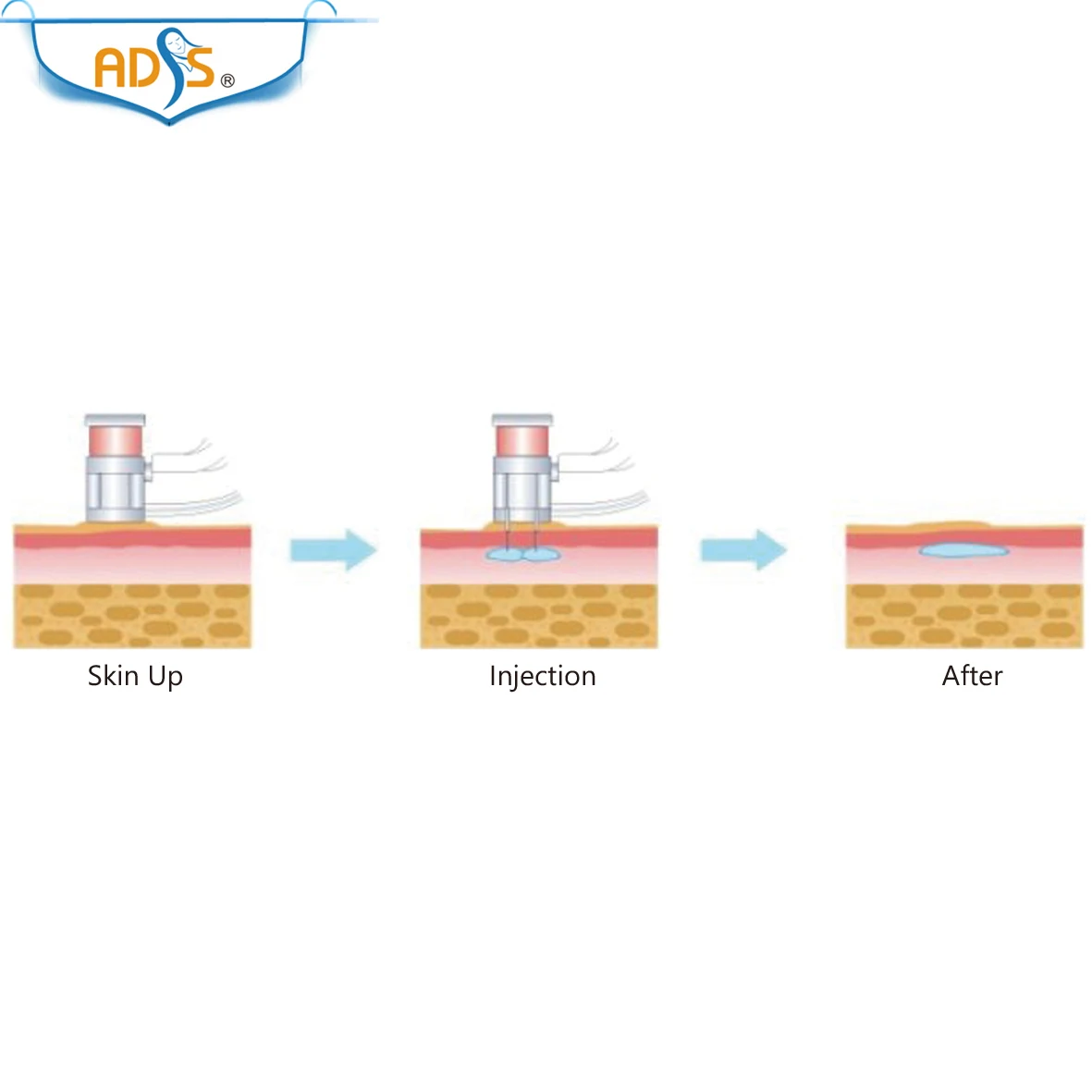 Хороший мини-стильный мезогун против акне и кожи, отбеливающий мезотерапевтический аппарат