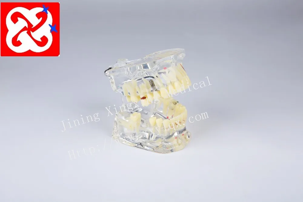 Adult pathological dental model with missing tooth caries apical cyst, tartar ,implant etc