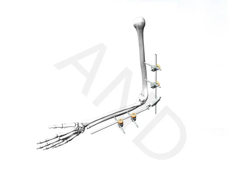 Ортопедический комбинированный 5 мм внешняя фиксация маленький костный фрагмент фиксатор верхней конечности ульна радиус коленчатый инструмент hoffman Stryker