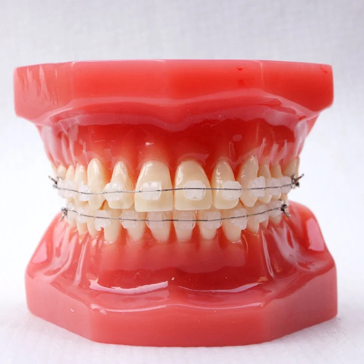 Dental Orthodontic model With metal bracket
