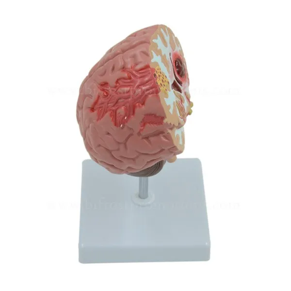 Organs Human Body Anatomy Brain Model Of Stroke
