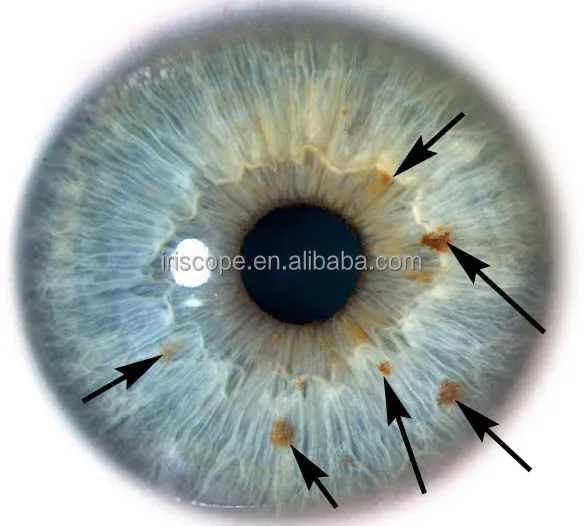 2016 latest 12.0 MP iriscope eye diagnostic cameras for therapists