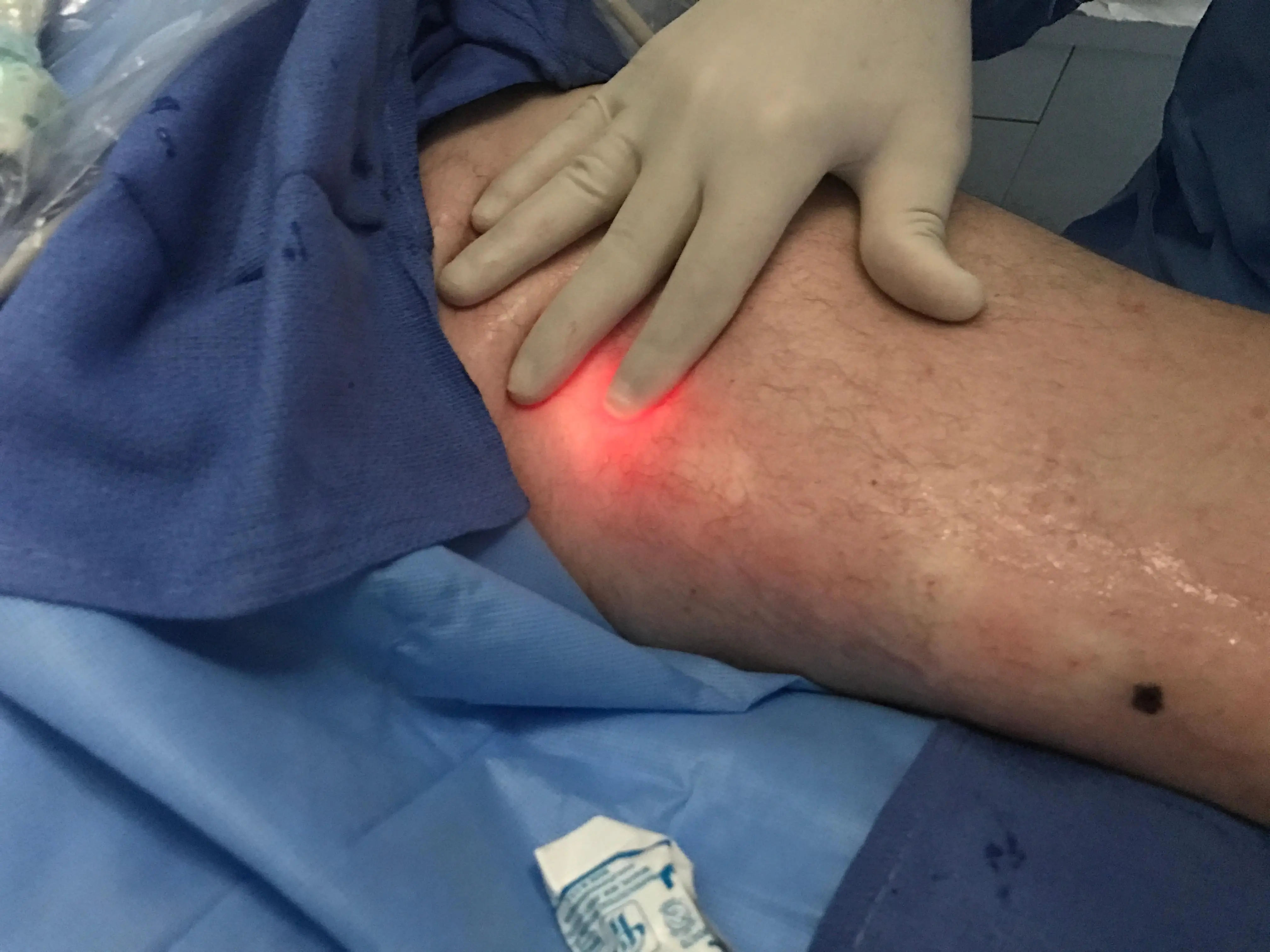 Varicose veins 1470nm laser surgery fiber,Surgery Laser Fiber