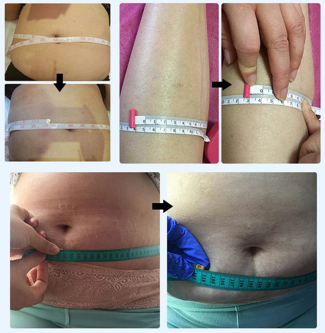 1064nm laser lipolysis liposuction plastic surgery
